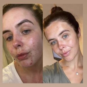 Antes y después limpieza facial LumiSpa iO piel con acné – Black Friday belleza 2025-7