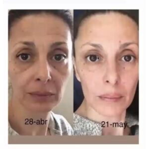 Antes y después limpieza facial LumiSpa iO piel madura 