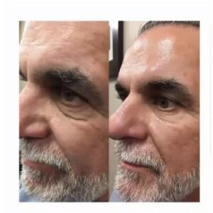 Antes y después limpieza facial LumiSpa iO piel madura 2