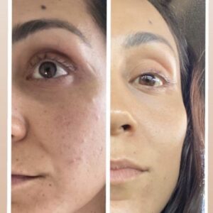 Antes y después limpieza facial LumiSpa iO piel con acné – Black Friday belleza 2025-6