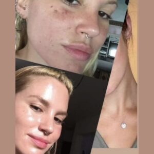 Antes y después limpieza facial LumiSpa iO piel con acné – Black Friday belleza 2025-5