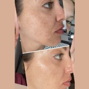 Antes y después limpieza facial LumiSpa iO piel con acné – Black Friday belleza 2025-4