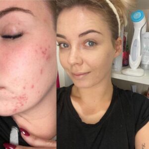 Antes y después limpieza facial LumiSpa iO piel con acné – Black Friday belleza 2025-3