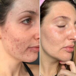 Antes y después limpieza facial LumiSpa iO piel con acné – Black Friday belleza 2025-2