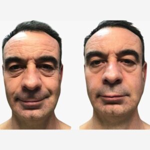 Antes y después limpieza facial LumiSpa iO piel madura 4