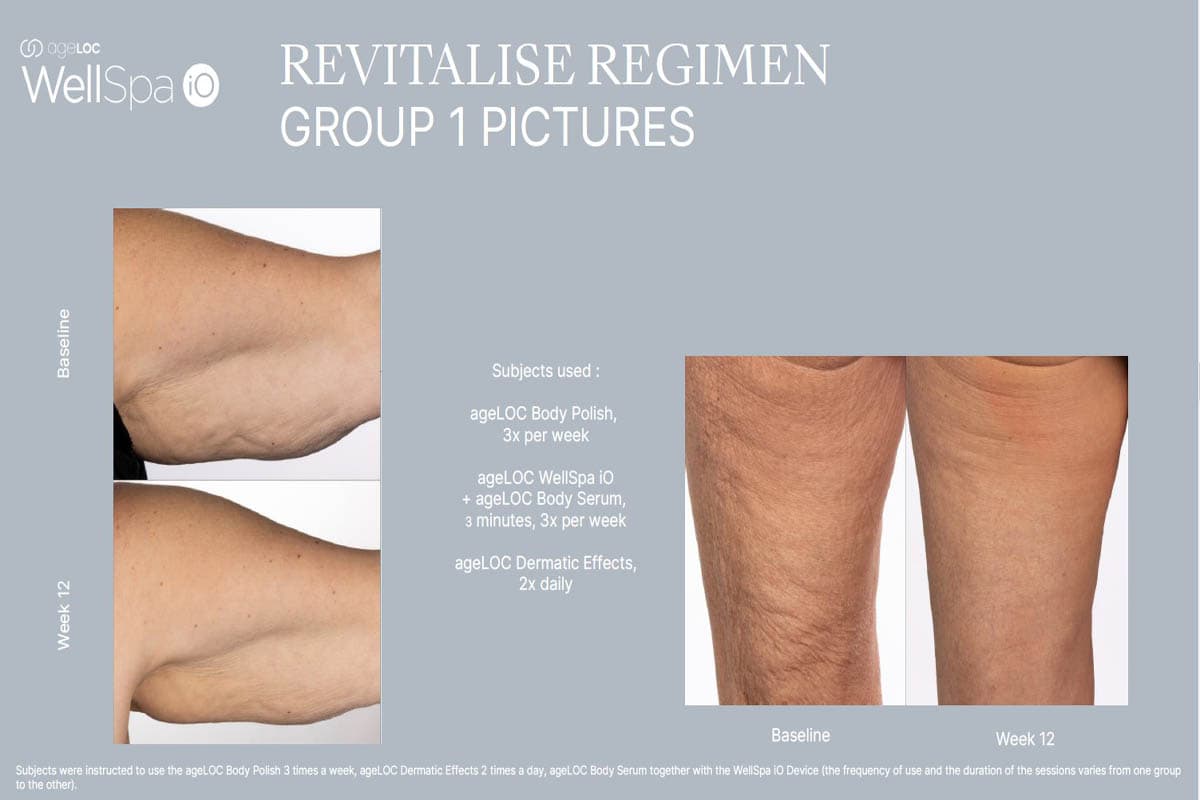 Antes y después del uso de ageLOC WellSpa iO Revitalise Regimen durante 12 semanas – mejora visible en la firmeza y textura del muslo y brazo.