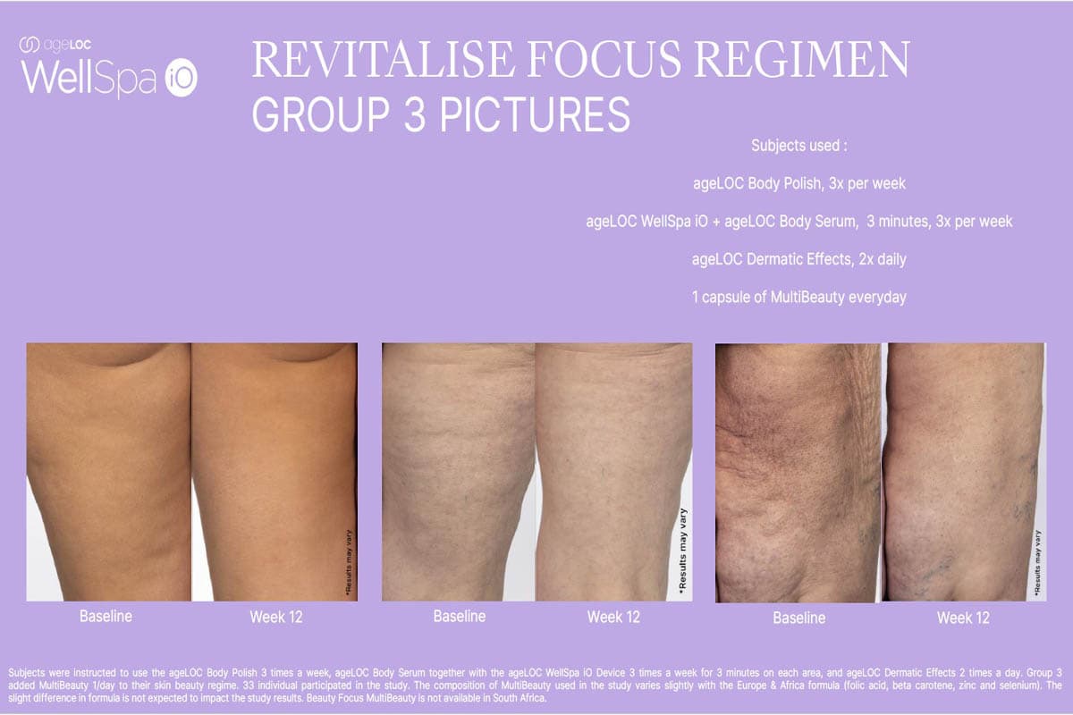 Resultados combinando WellSpa iO + MultiBeauty durante 12 semanas – firmeza y tono visiblemente mejorados.
