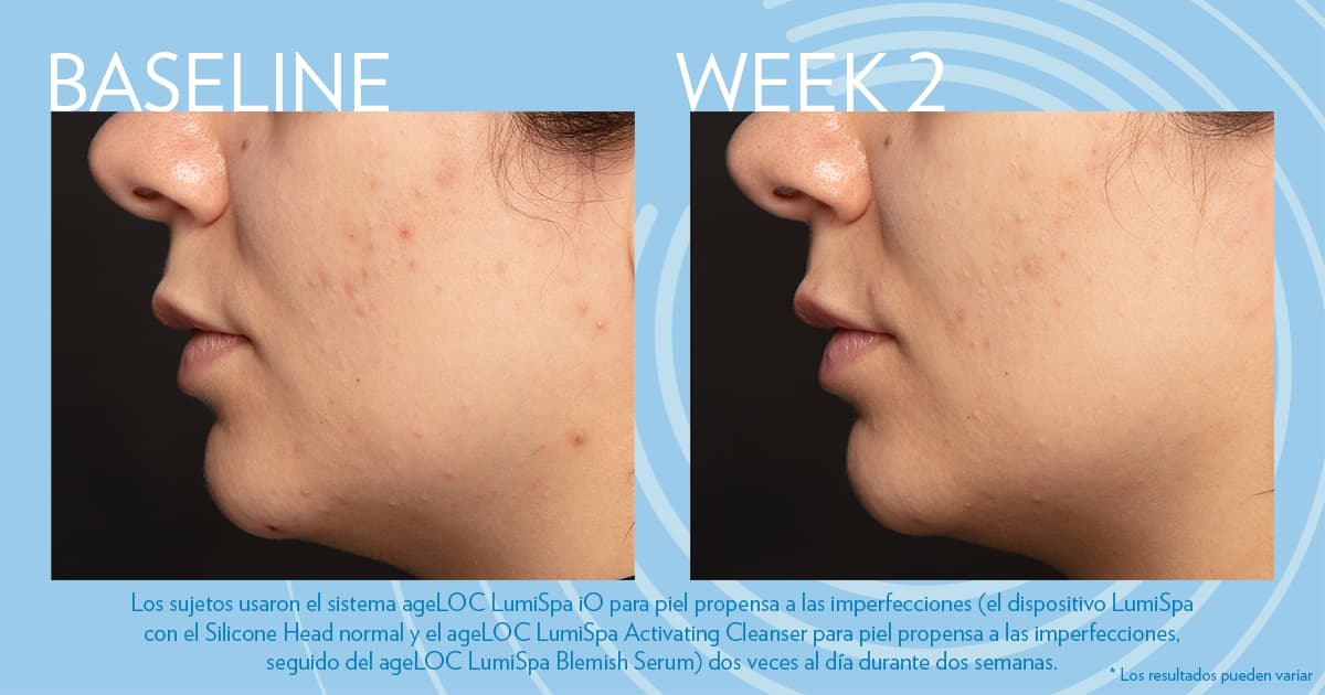 Estudios sobre el envejecimiento: Resultados del uso combinado de ageLOC LumiSpa y Blemish Serum: limpieza profunda y piel más suave