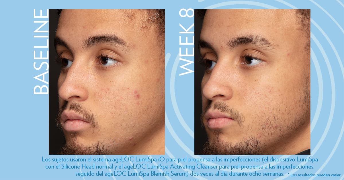 Estudios sobre el envejecimiento: Piel más luminosa y uniforme después de 12 semanas de tratamiento con ageLOC LumiSpa y Blemish Serum