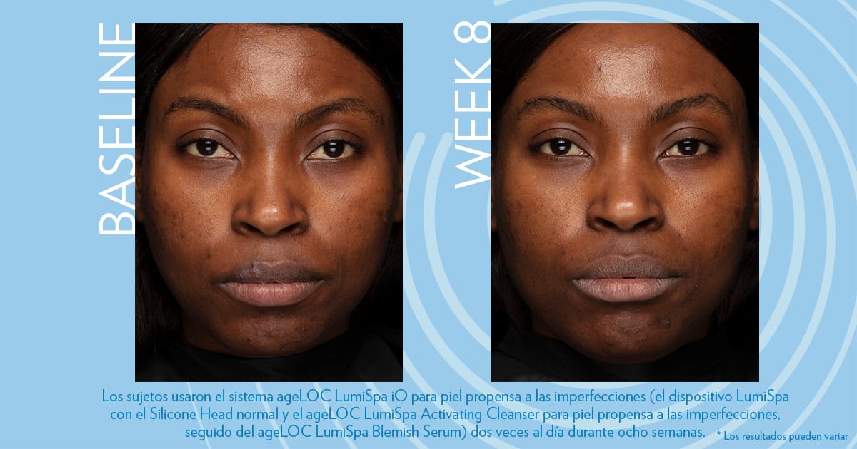 Estudios sobre el envejecimiento: Disminución del tamaño de los poros y textura más uniforme tras 12 semanas con ageLOC LumiSpa y Blemish Serum