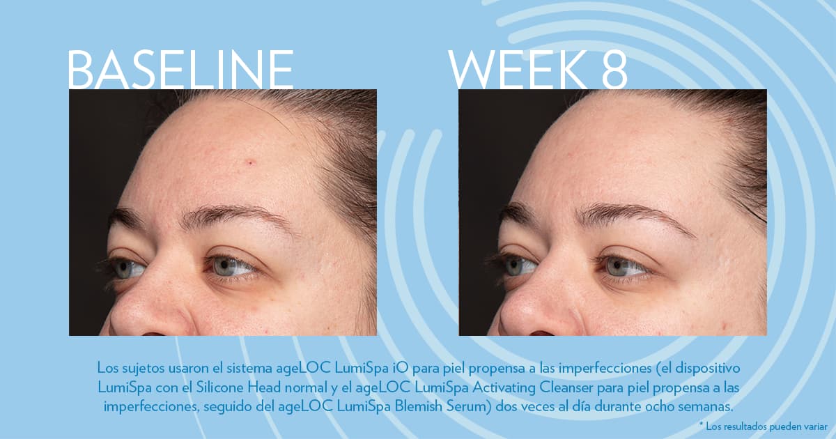 Estudios sobre el envejecimiento: ageLOC LumiSpa Blemish Serum
